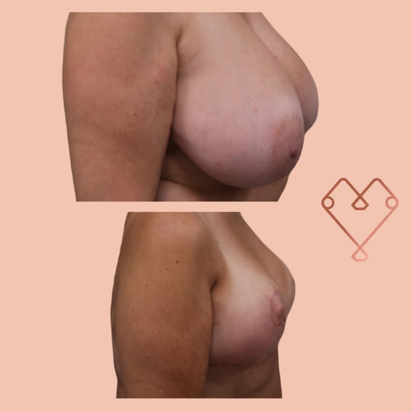 reducción de mamas 2