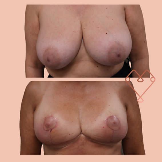reducción de mamas 4