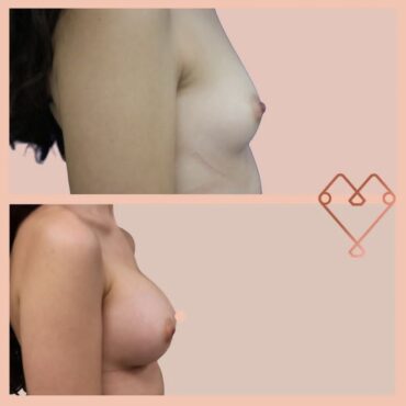 aumento de mamas