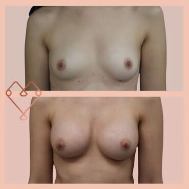 aumento de mamas 4