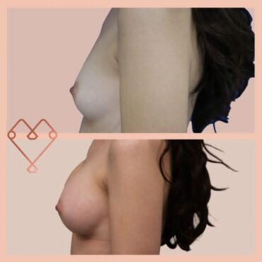 aumento de mamas 2