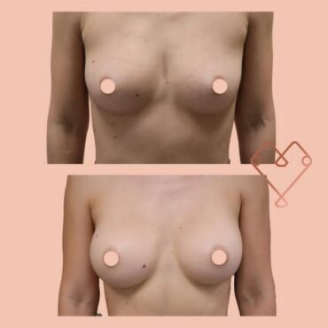 aumento mamario 4