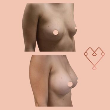 aumento mamario 3